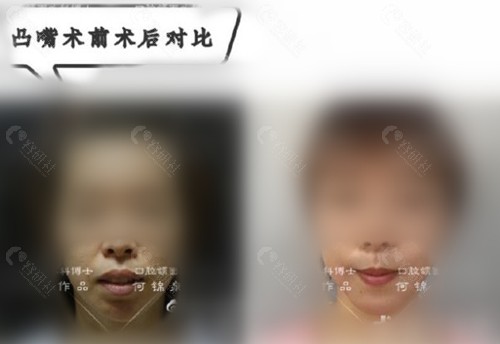 广州广大骨性凸嘴正颌手术前后对比图