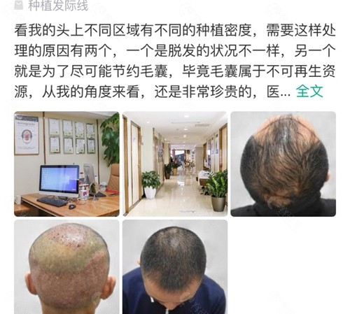 网友在新生毛发植发医院做头顶加密种植口碑评价