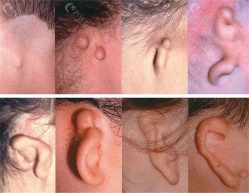 耳朵畸形照片一览