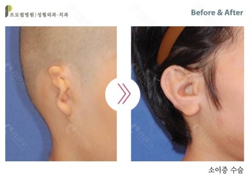 耳再造手术前后对比照
