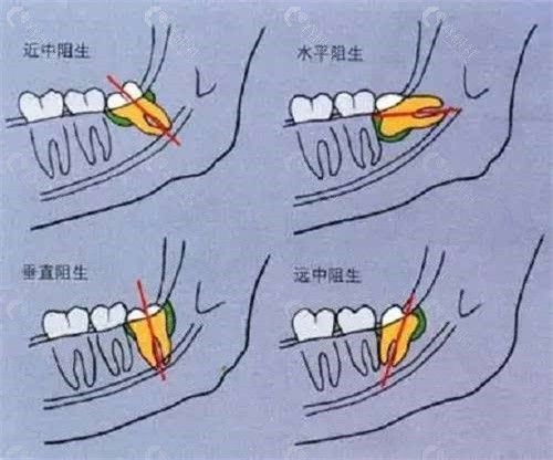 拔智齿如何避免被坑？