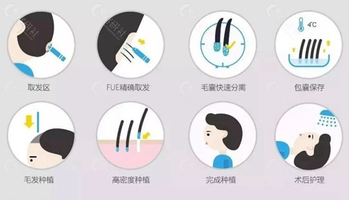 武汉植发医院哪里好?种植头发需要多少钱?成活率高吗? 