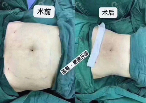 北京薇琳腰腹部吸脂前后对比照