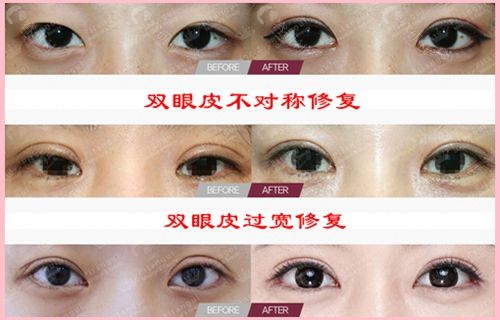 北京擅长做双眼皮、眼综合、高难度眼修复的医生都有谁？