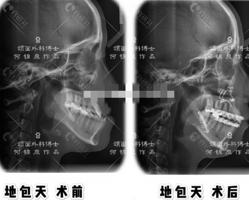 广州广大何锦泉正颌手术前后对比照