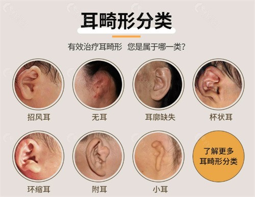 耳朵畸形分类