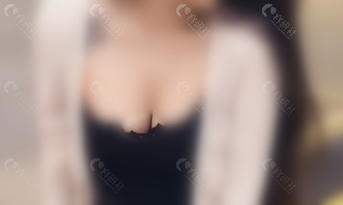 韩国普罗菲耳隆胸修复真人图片