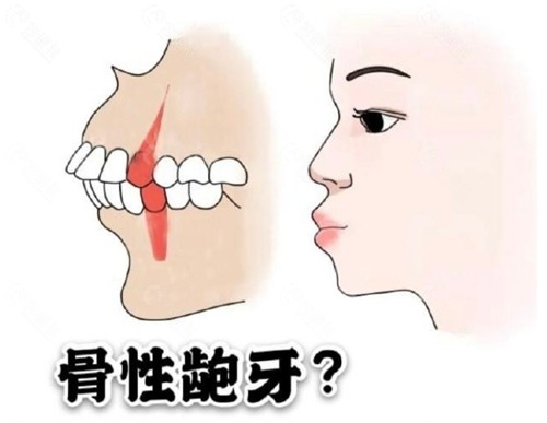 骨性龅牙和牙性龅牙