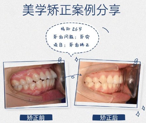 深圳美奥口腔正畸前后对比照