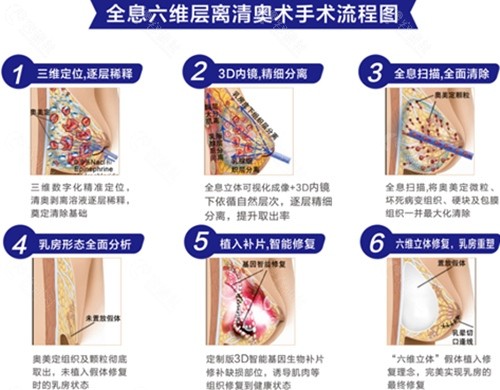 广州荔湾区人民医院奥美定隆胸修复技术优势介绍