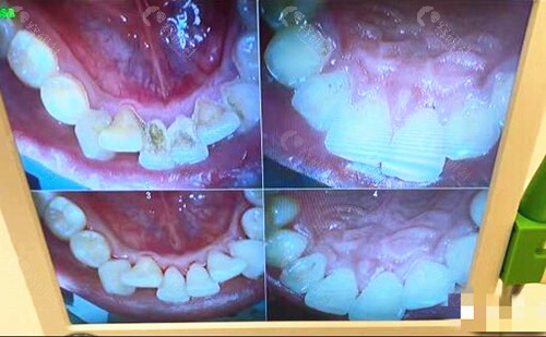 北京西诺口腔医院牙齿矫正真人实例