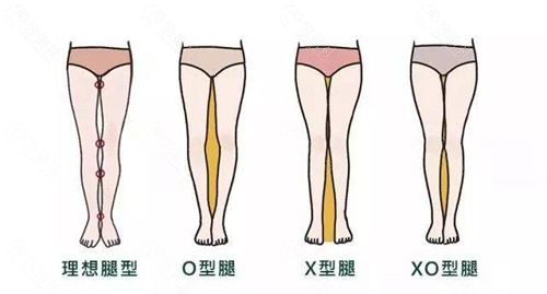 正常腿型和x/o型腿的区别