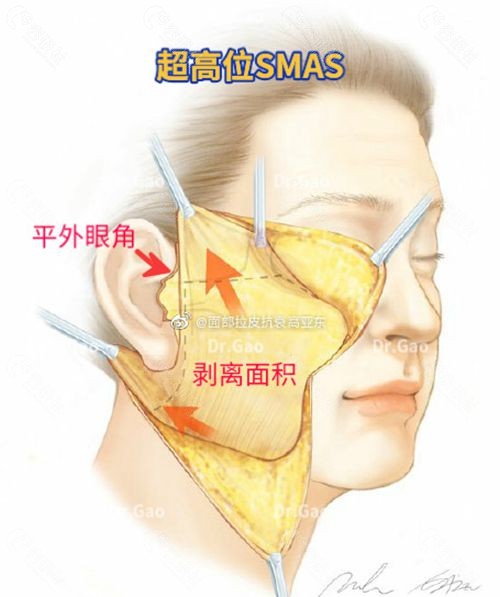 北京华韩高亚东超高位SMAS拉皮除皱原理