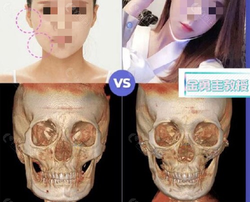 上海美联臣金勇圭颧骨+下颌角术前术后对比