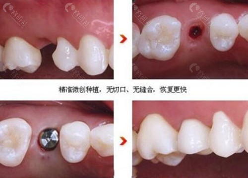 中诺口腔医院种植牙技术优势