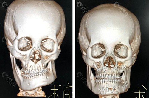 四川省人民医院友谊医院正颌前后对比照