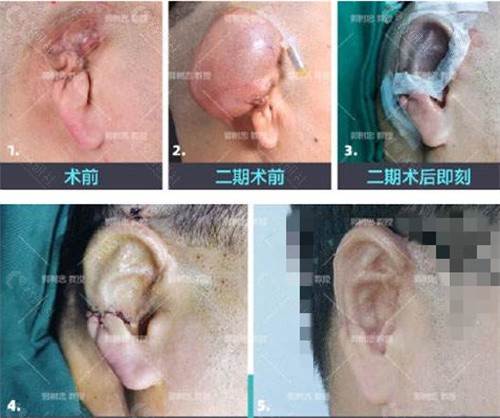 西安国医耳畸形患者反馈