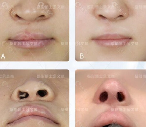 广州高尚唇腭裂修复术前术后对比