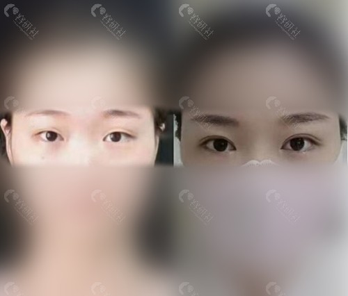 郑州大学第二附属医院李钢双眼皮术前术后对比