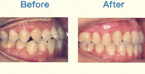北京禾禾齿科牙齿矫正前后对比照