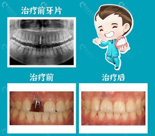 深圳格伦菲尔口腔种植牙前后对比照