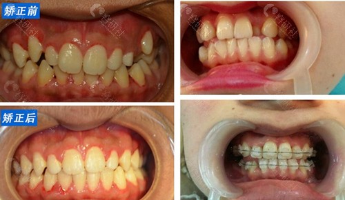 深圳同步齿科牙齿矫正前后对比图