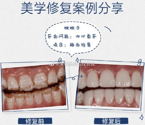 深圳美奥口腔牙齿美学修复术前术后对比