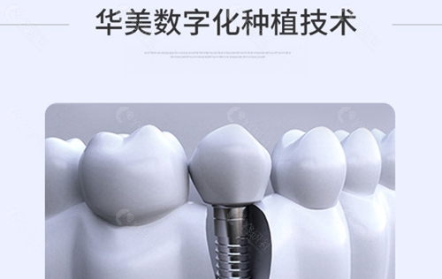 海南华美口腔数字化种植牙技术