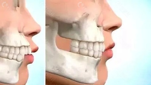 骨性龅牙手术哪家医院好？