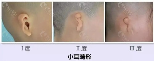 小耳畸形1度2度3度图片