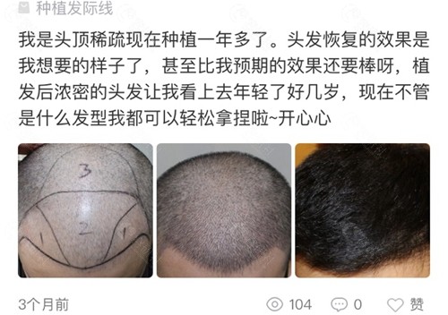 网友在北京大麦植发医院做头顶加密种植口碑评价