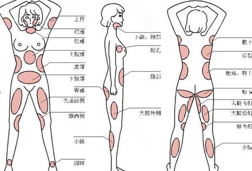 吸脂不同部位