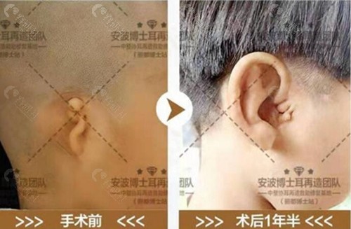 北京丽都安波治疗小耳畸形前后对比照