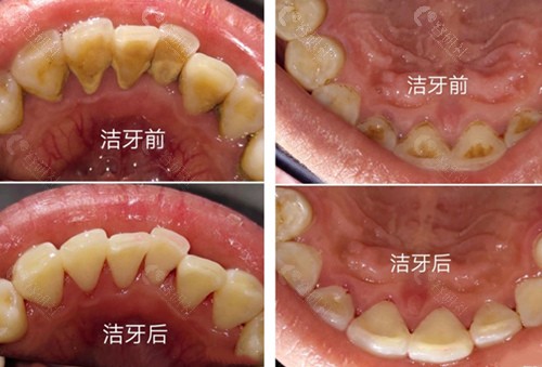 黔西金铂士口腔洗牙前后对比照