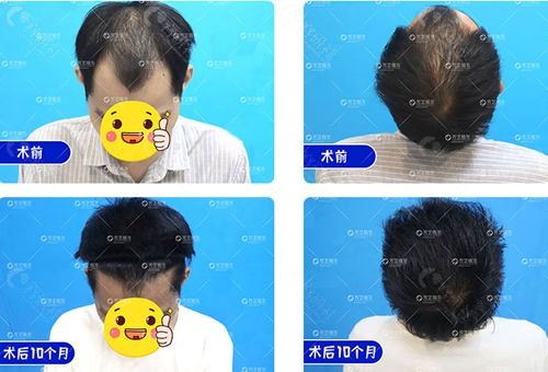 郑州芳艺植发男士大面积脱发诊疗及种植前后图片