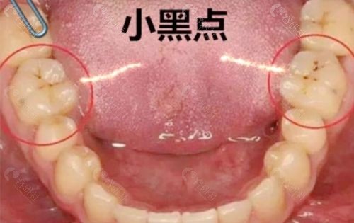 孩子长蛀牙了，牙齿上出现了小黑点，补牙用哪种材料好？