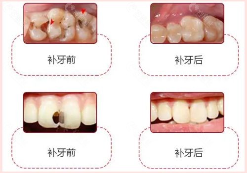 补牙用哪种材料比较合适？树脂补牙材料对人体有害吗？