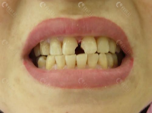 门牙牙缝大成年人补牙选哪种材料好？