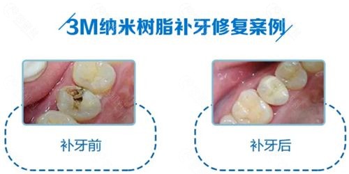 3M纳米树脂补牙修复前后图片