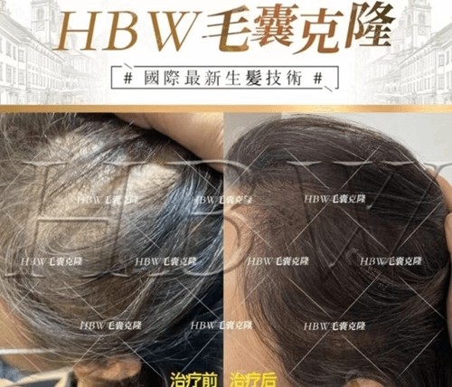 hbw毛囊克隆植髮騙局揭秘附國內毛囊克隆植髮好醫院及價格