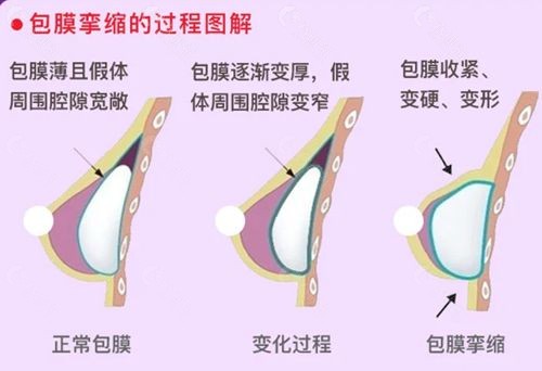 假体隆胸后出现包膜挛缩的过程图解