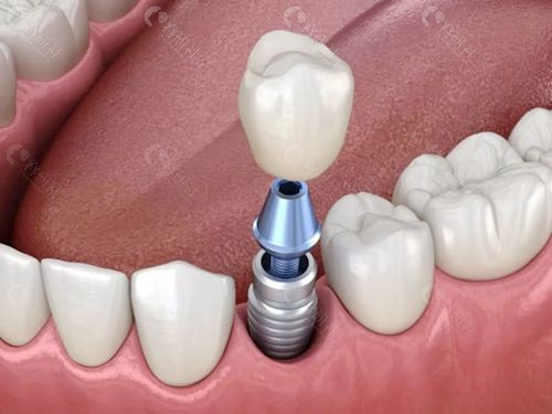 牙医说千万不要做种植牙是在担心种植牙没有真牙坚固耐用吗？