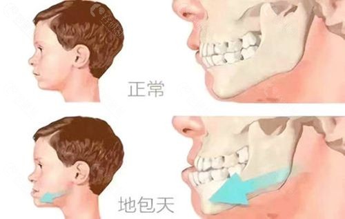 颌面畸形和正常脸型区别