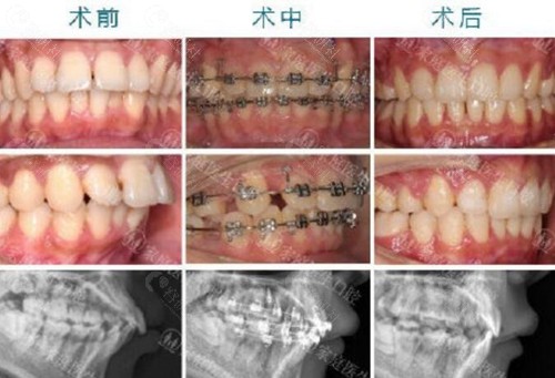 广州中家医家庭医生口腔医院牙齿矫正真人实例