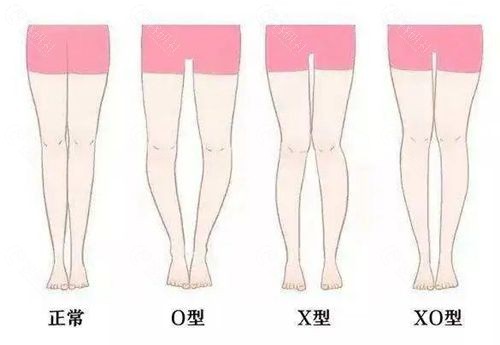 正常腿型和X/O型腿的区别