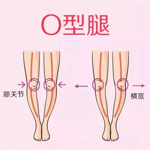 O型腿的主要表现