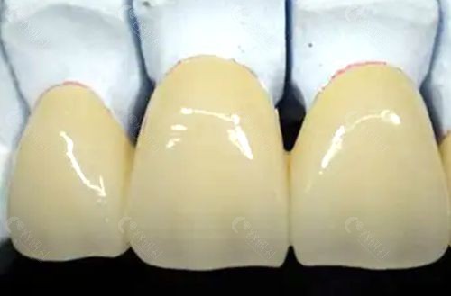 钛合金烤瓷牙有哪些优缺点？