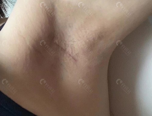 韩国普罗菲耳假体隆胸切口展示