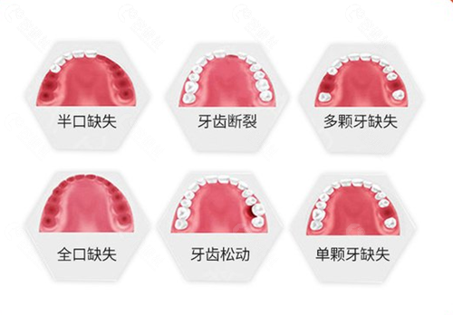 牙齿缺失的情况