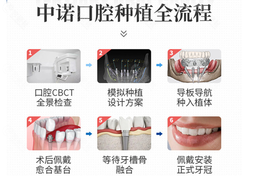 北京中诺口腔医院种植牙流程